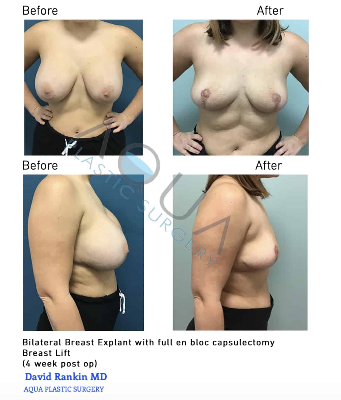 My Breast Implant and Explant Journey — Laurenda Marie