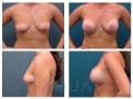 breast_lift-19