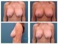breast_lift-20