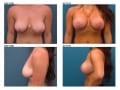 breast_lift-17