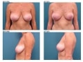 breast_lift-18