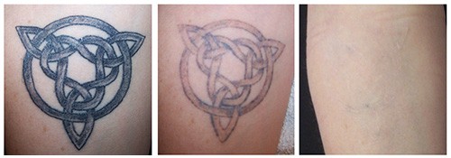 Laser Tattoo Removal Services in Fort Myers and Naples FL  239 4315432
