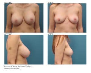 Breast Implant Removal Patient Photos Jupiter, FL