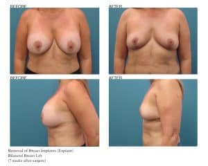 Breast Explant Patient Photos Jupiter, FL