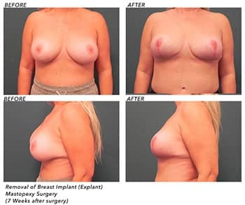 Breast Explant Patient Before and After photos Jupiter, FL