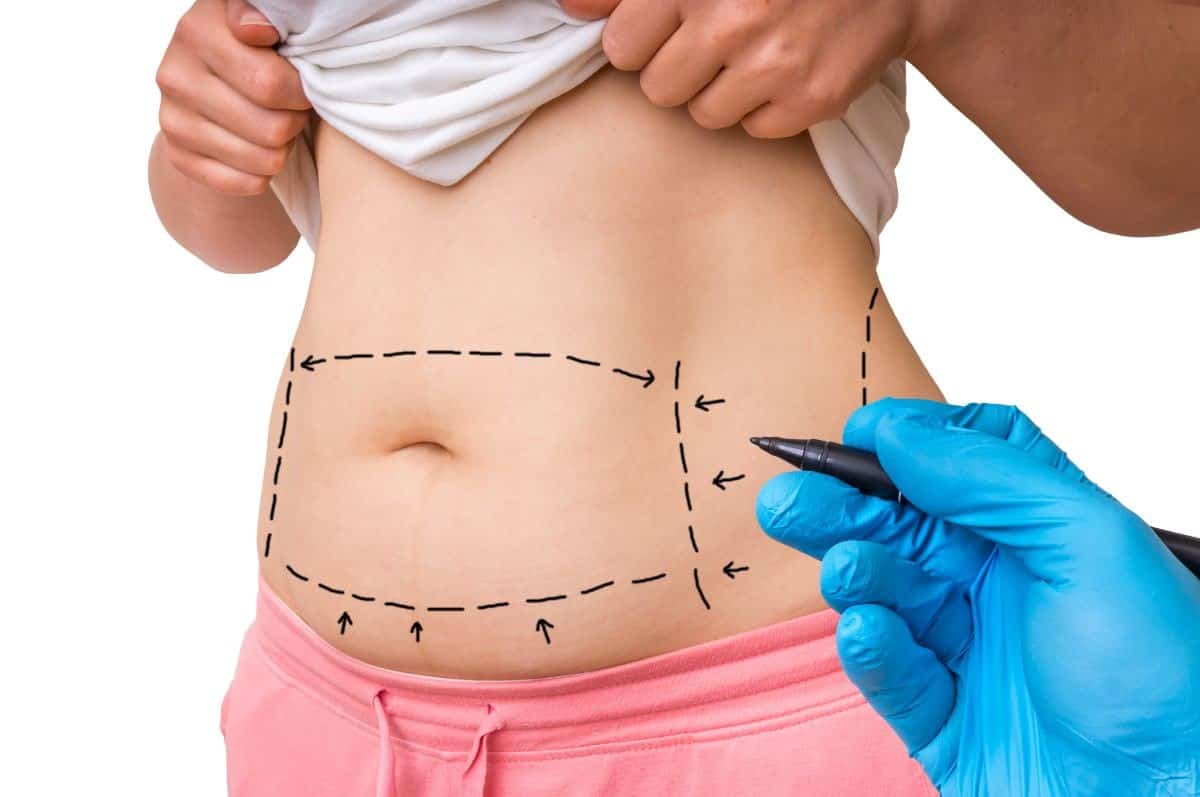 Tummy tuck in Jupiter, FL