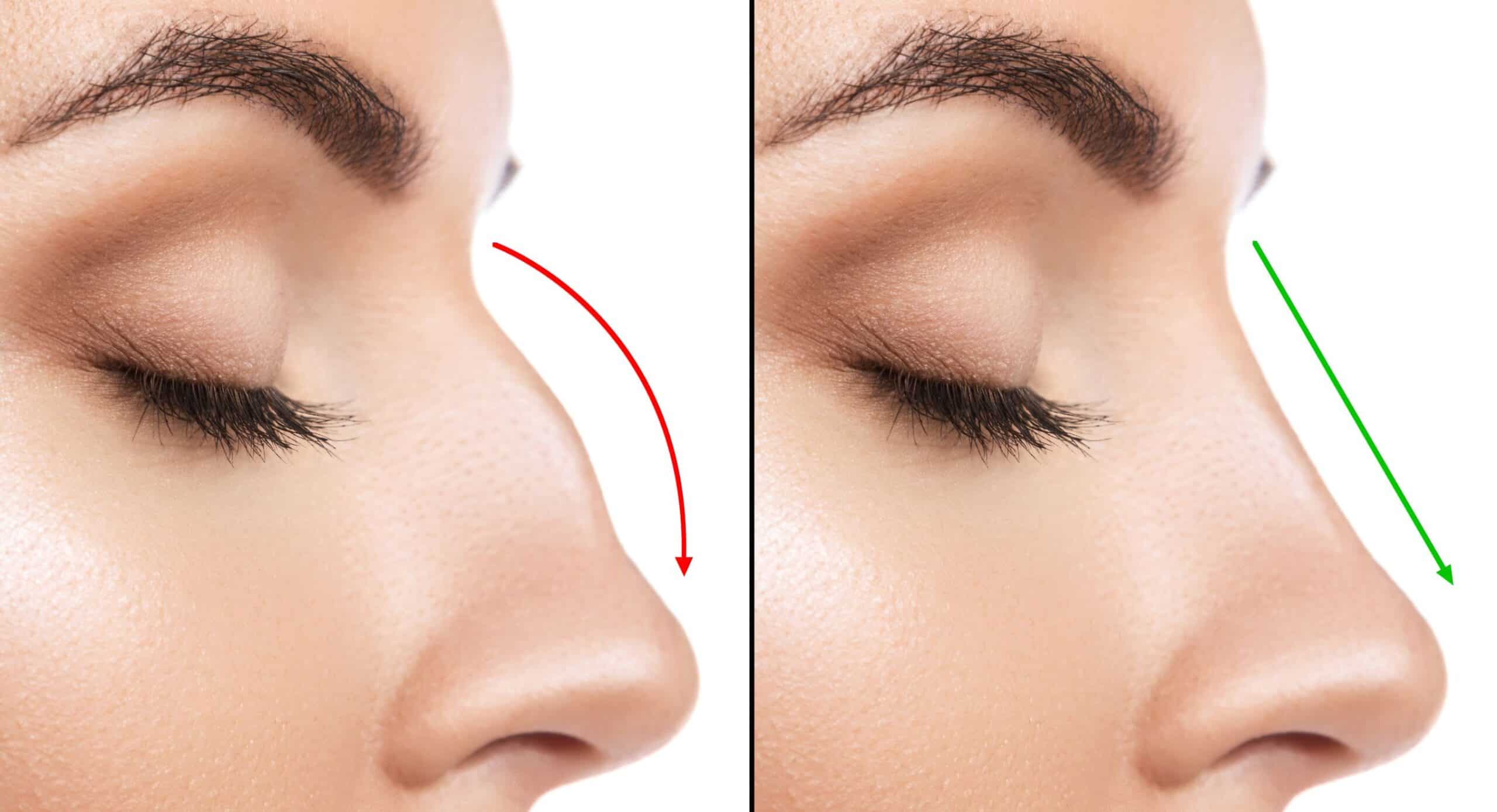 Rhinoplasty in Jupiter, FL; lines show how surgery changed the angle of a woman's nose