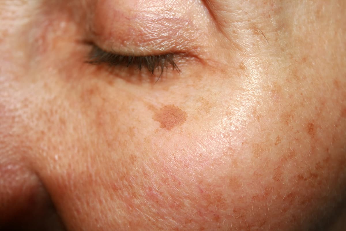 Sun damage treatments Jupiter, FL