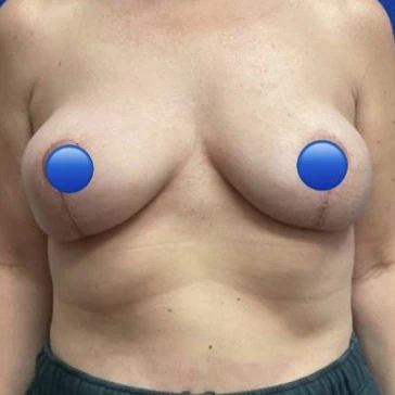 After - Case #4392: Breast Explant and Lollipop Lift