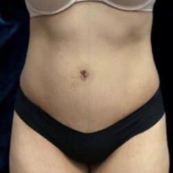 Front view of case 4373 involving a patient shown after tummy tuck by Dr. Rankin in Jupiter, FL.