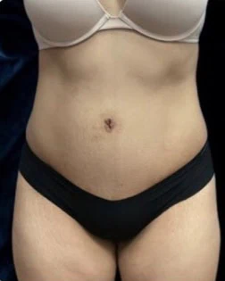 After - Case #4373: Tummy Tuck