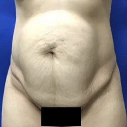 Front view of case 4373 involving a patient shown before tummy tuck by Dr. Rankin in Jupiter, FL.