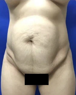 Before - Case #4373: Tummy Tuck