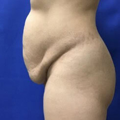Left view of case 4373 involving a patient shown before tummy tuck by Dr. Rankin in Jupiter, FL.