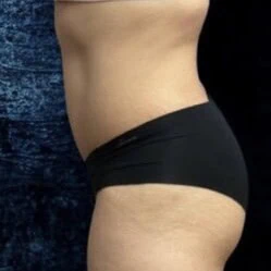 Left view of case 4373 involving a patient shown before tummy tuck by Dr. Rankin in Jupiter, FL.