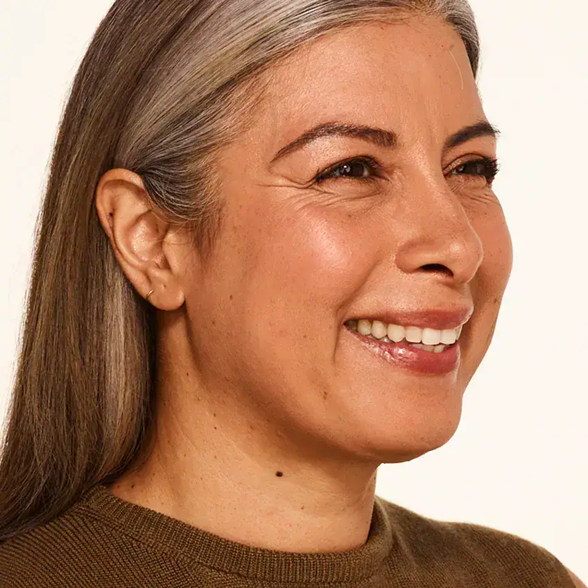 Right-view before Botox treatment of woman with severe crow's feet at the crease of her eyes.