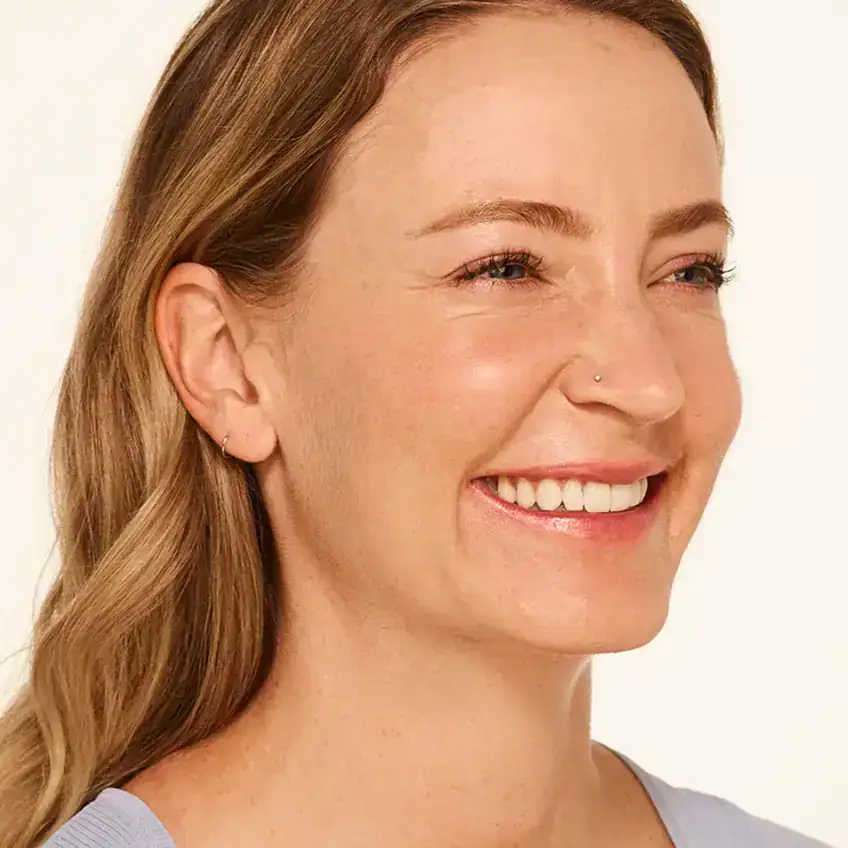 Right-view before Botox treatment of woman with moderate crow's feet at the crease of her eyes.