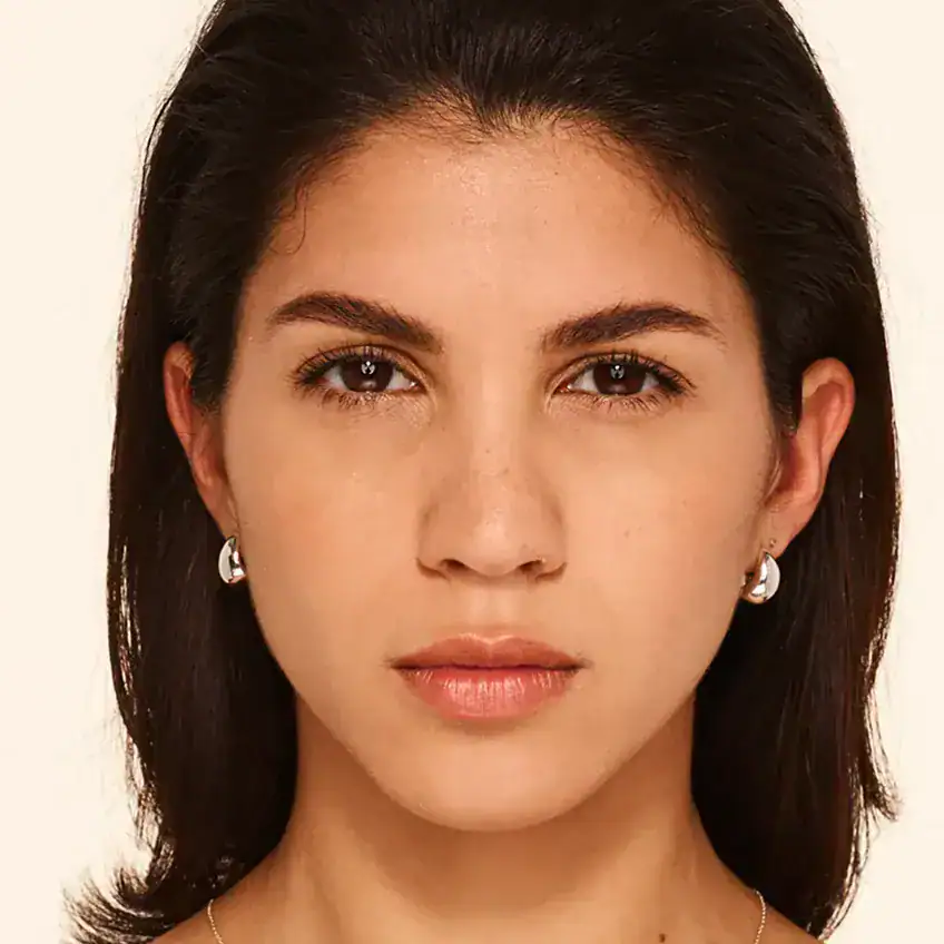 Front-view after Botox treatment of woman with smooth skin between her eyes - no more frown lines.