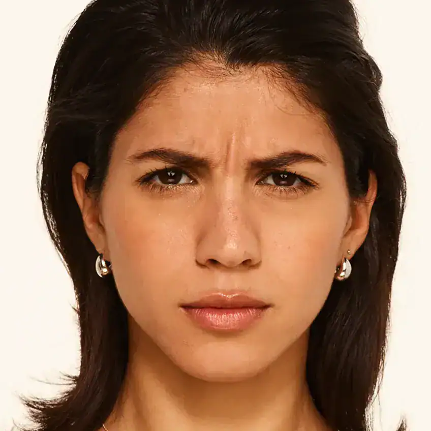 Front-view before Botox treatment of woman with frown lines between her eyes.