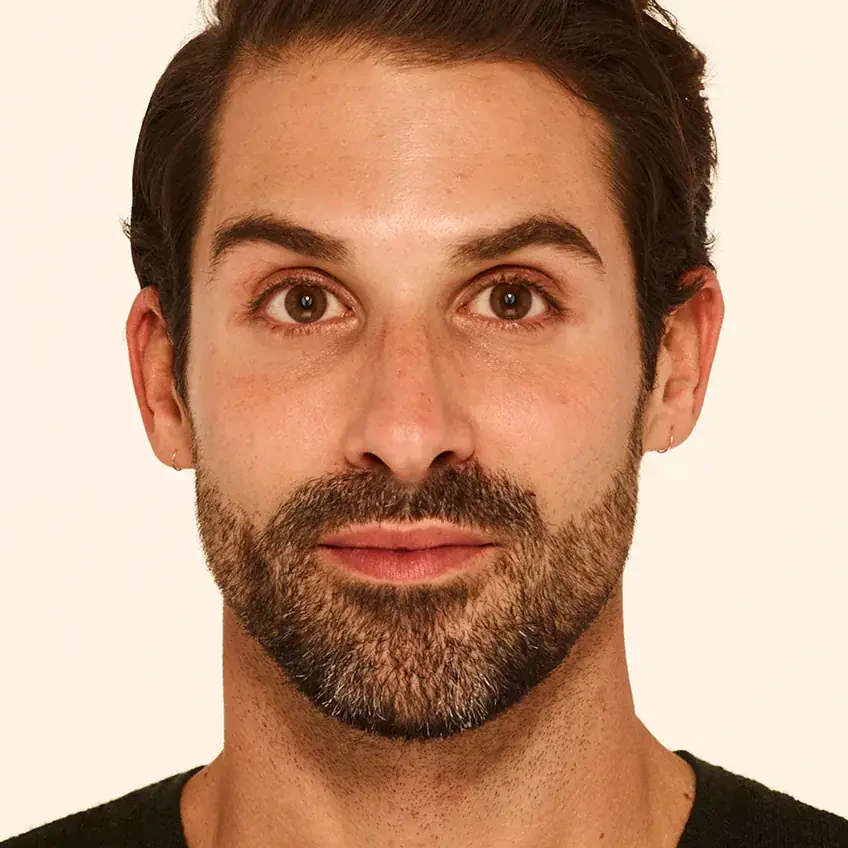 Front-view after Botox treatment of man with smoother forehead.