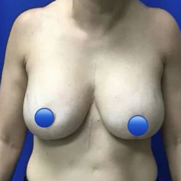 Front view of breast explant case 4362 involving a woman in her 40s shown before surgery with Dr. Rankin in Jupiter, FL.