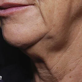 Left-view after Morpheus8 treatment of woman's smoother looking neck with fewer wrinkles, tighter skin.