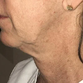 Left-view after Morpheus8 treatment of woman's neck with smoother look with fewer wrinkles, less sagging skin.