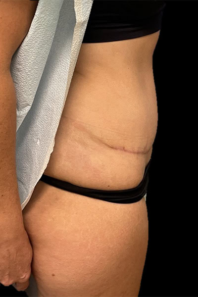 After - Case #3504: Tummy Tuck