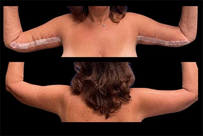 After - Case #3503: Arm Lift Surgery (Brachioplasty)