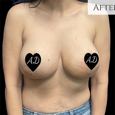 After - Case #3510: Breast Augmentation and Lift