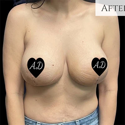 After - Case #3510: Breast Augmentation and Lift