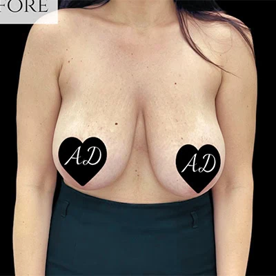 Before - Case #3510: Breast Augmentation and Lift