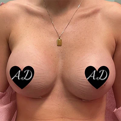 After - Case #3516: Breast Augmentation
