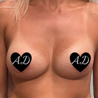 After - Case #3506: Breast Augmentation