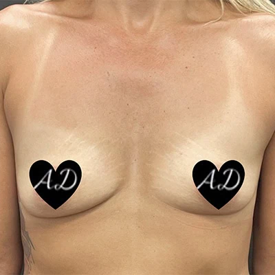 Before - Case #3506: Breast Augmentation