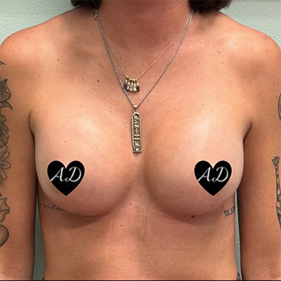 After - Case #3515: Breast Augmentation