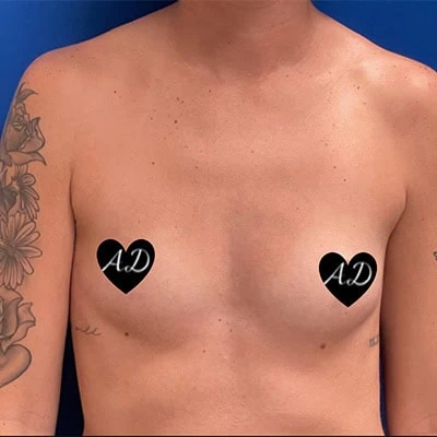 Before - Case #3515: Breast Augmentation