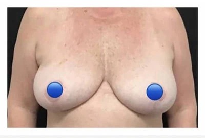 After - Case #4147: Breast Explant and Wise Lift