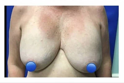 Before - Case #4147: Breast Explant and Wise Lift