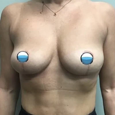After - Case #4154: Breast Explant and Anchor Lift