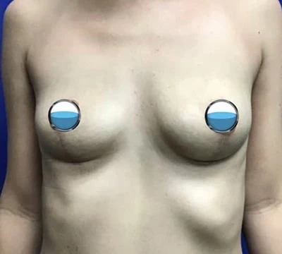 After - Case #4166: Breast Explant and Lift