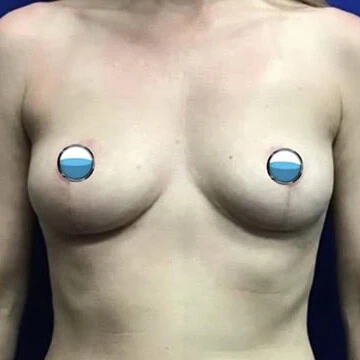 Front-view after photo of breast explant and lift surgery performed by Dr. David Rankin in Jupiter, FL, case 4169.