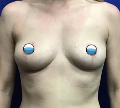 After - Case #4169: Breast Explant and Lift