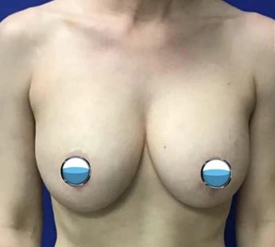 Before - Case #4169: Breast Explant and Lift