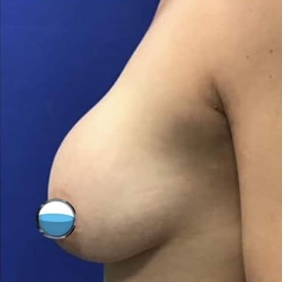 Before - Case #4172: Breast Explant and Lift