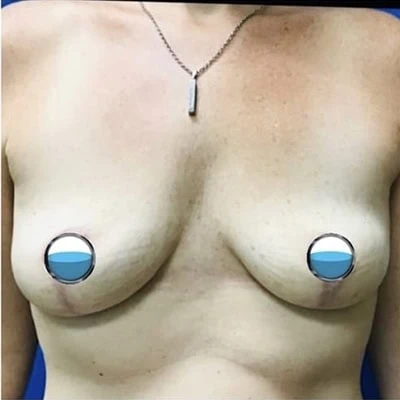 After - Case #4175: Breast Explant and Anchor Lift