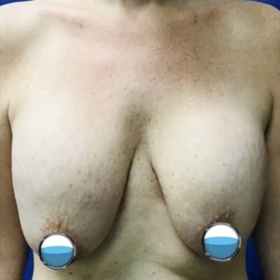 Before - Case #4175: Breast Explant and Anchor Lift