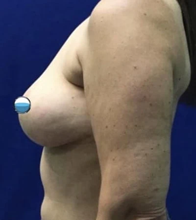 After - Case #4183: Breast Explant and Lift