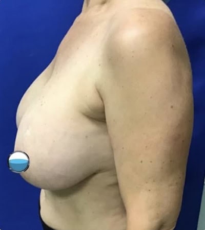 Before - Case #4183: Breast Explant and Lift