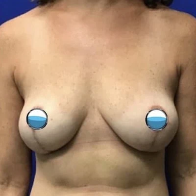 After - Case #4189: Breast Explant and Lollipop Lift